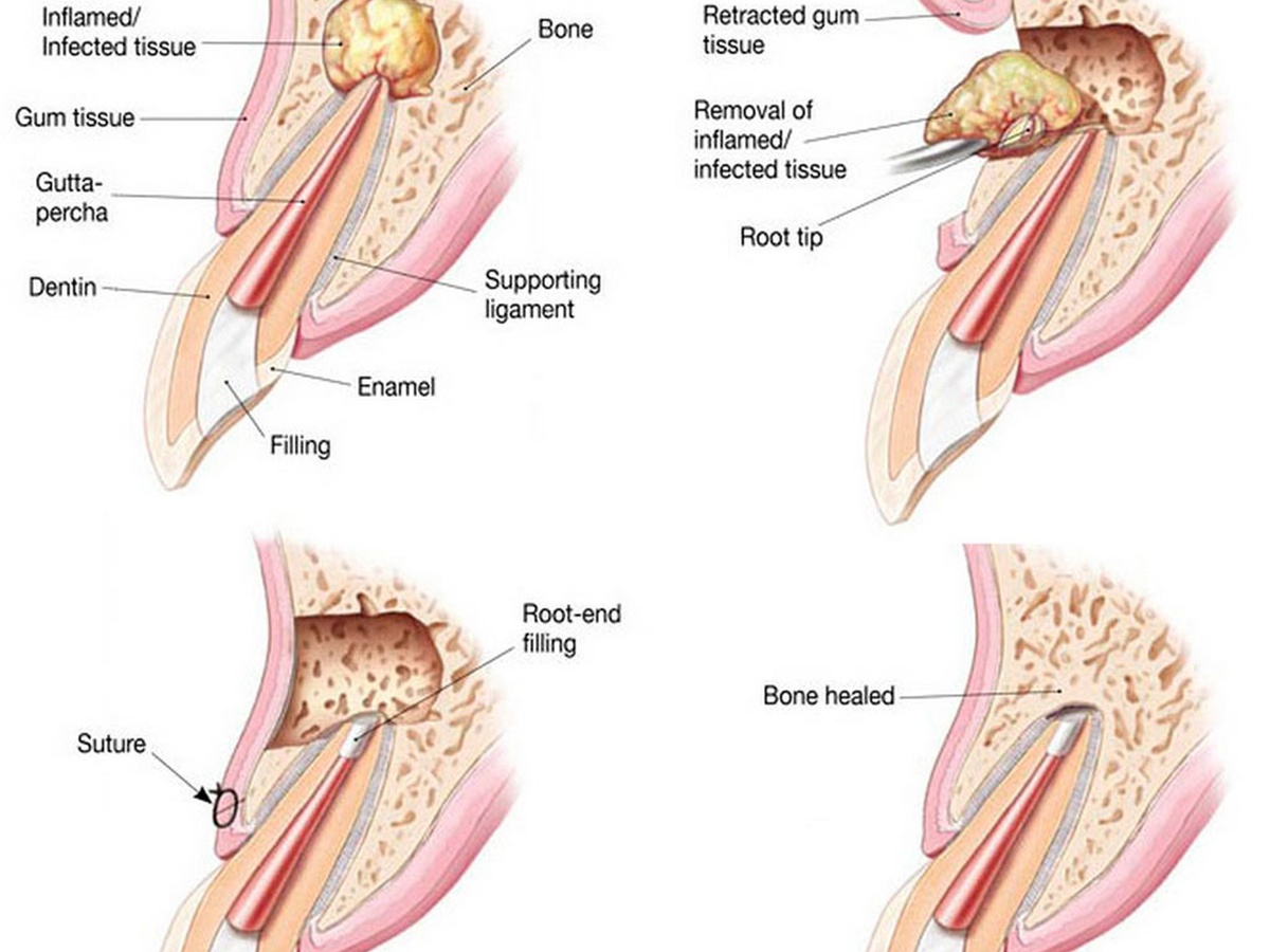 신길 치과 임플란트와 자연치 보존 — 재신경치료·치근단수술·발치로 이어지는 단계적 의사결정 이미지 (1200x900px)